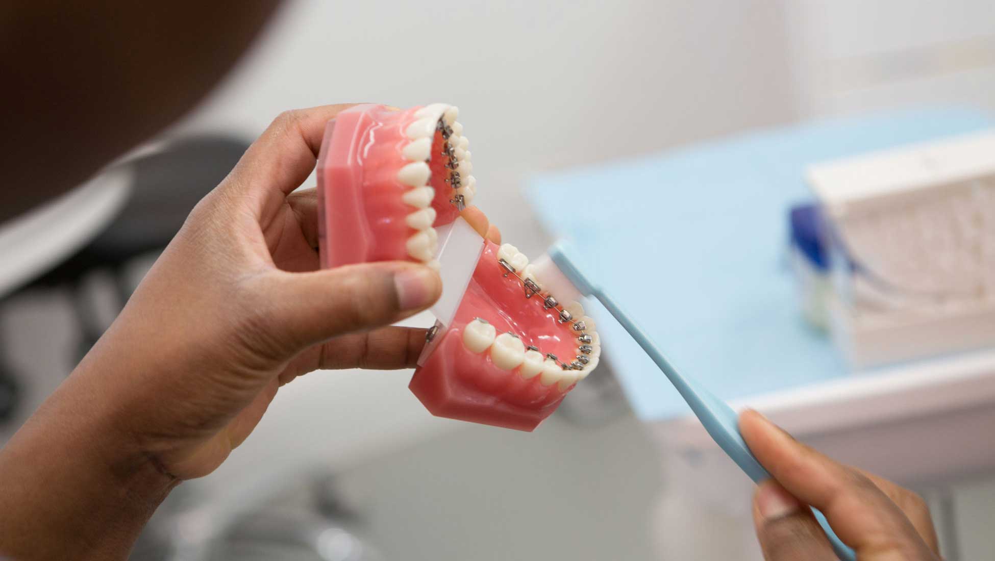 LINGUAL BRACES TREATMENT