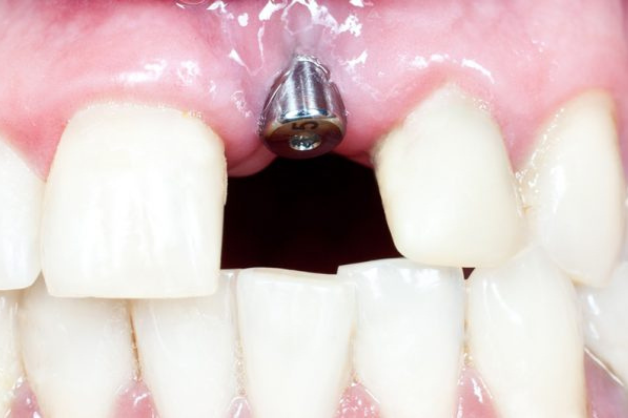 Immediate Dental Implant